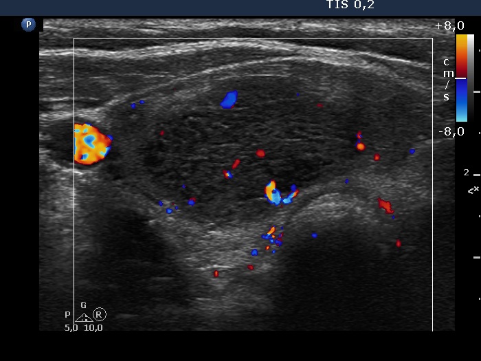 Right lobe, longitudinal scan