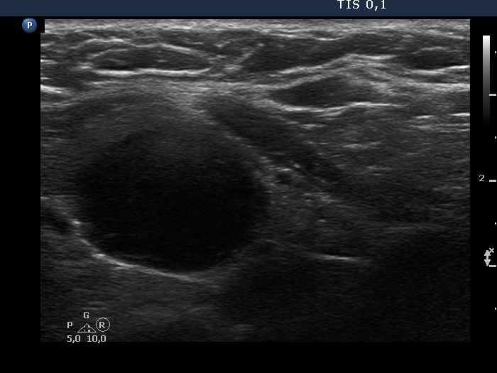 Right lobe, longitudinal scan
