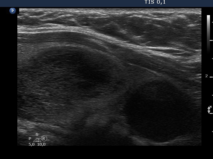 Right lobe, longitudinal scan