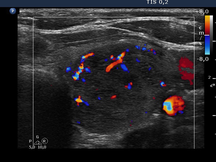 Right lobe, longitudinal scan
