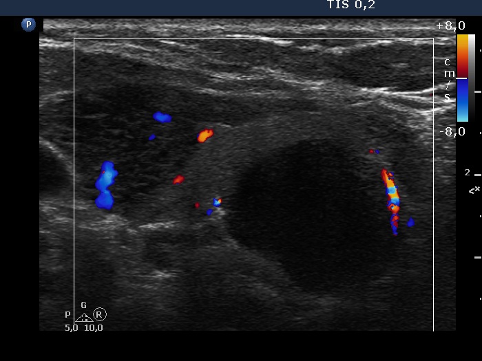 Right lobe, longitudinal scan