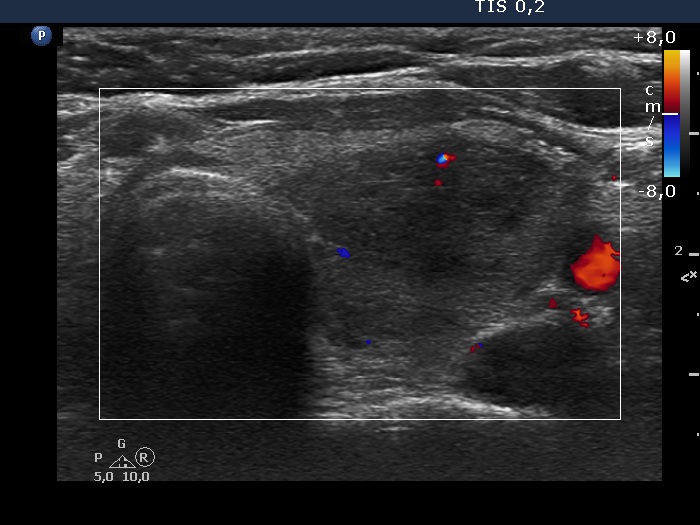 Right lobe, longitudinal scan