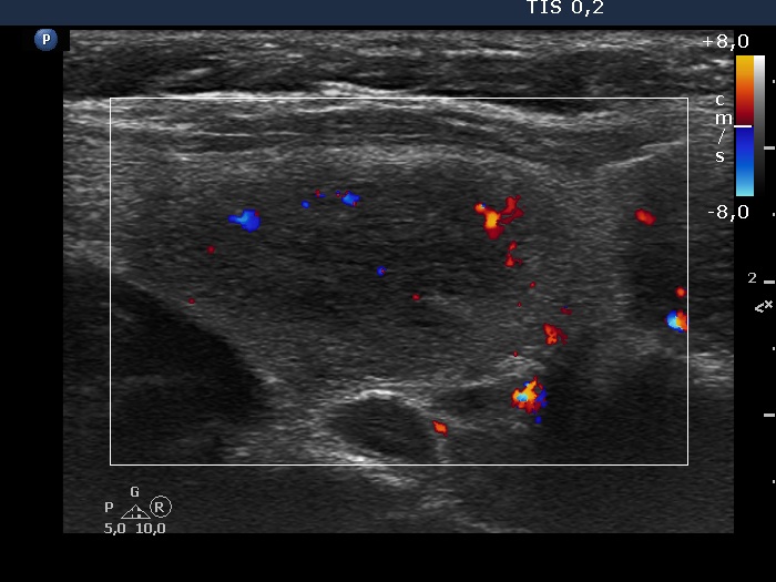 Right lobe, longitudinal scan