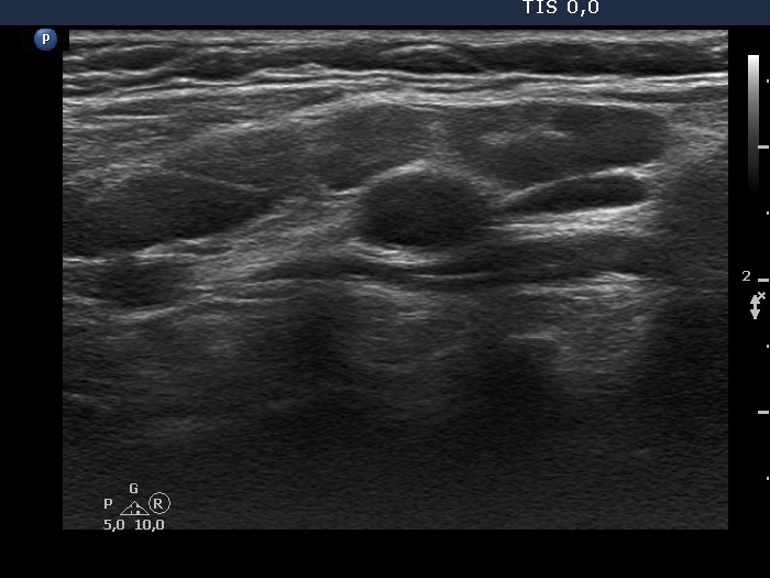 Right lobe, longitudinal scan