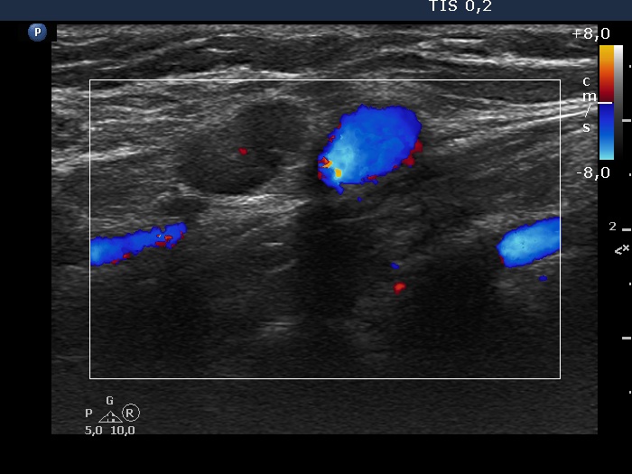 Right lobe, longitudinal scan