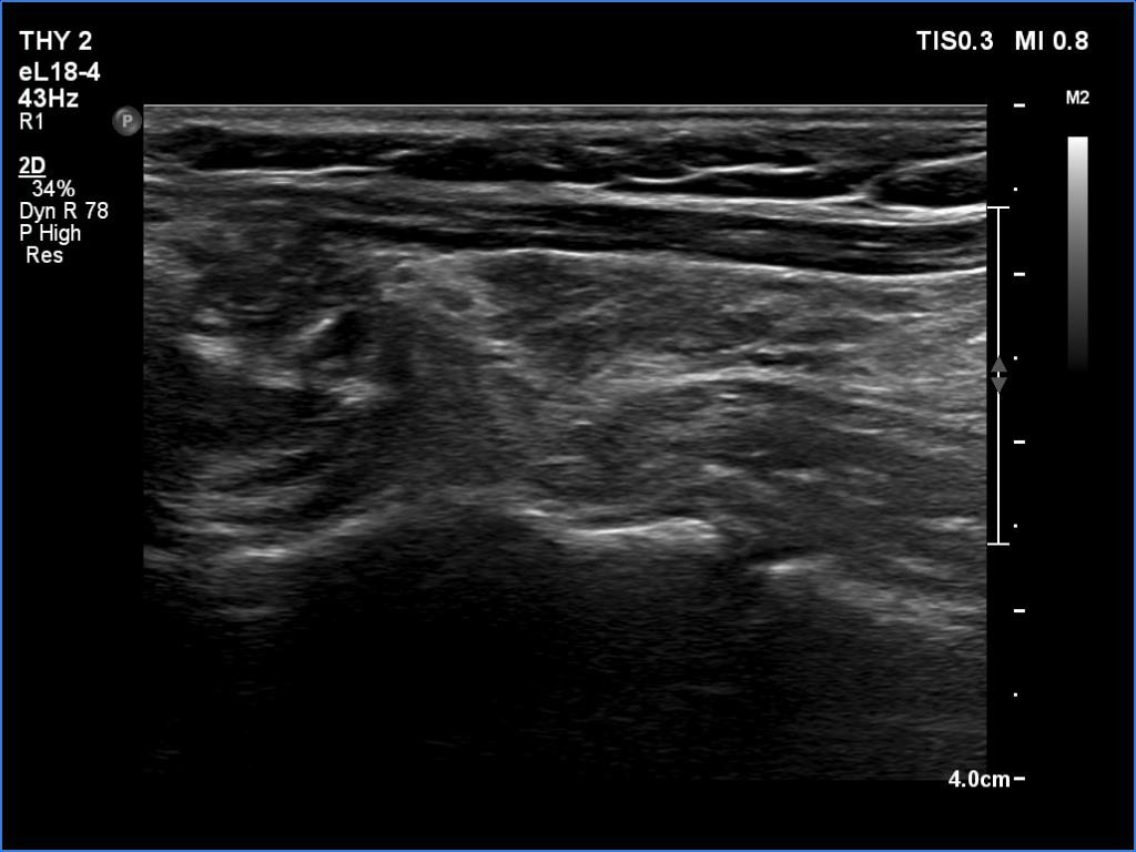 Right lobe, longitudinal scan