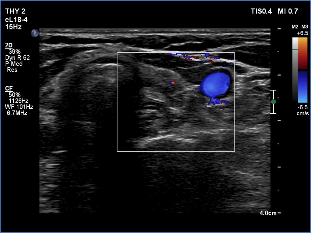Right lobe, longitudinal scan