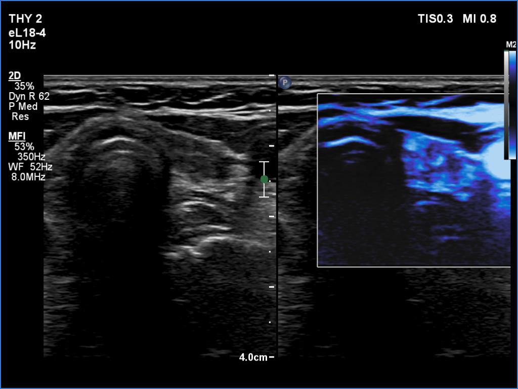 Right lobe, longitudinal scan