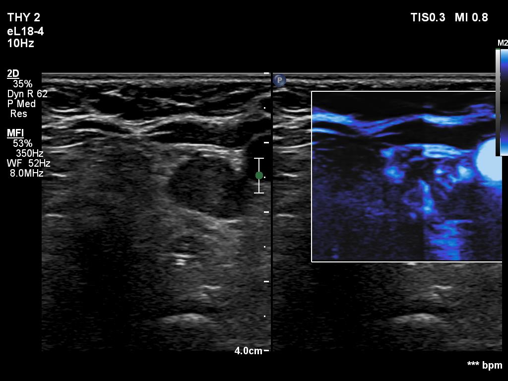 Right lobe, longitudinal scan