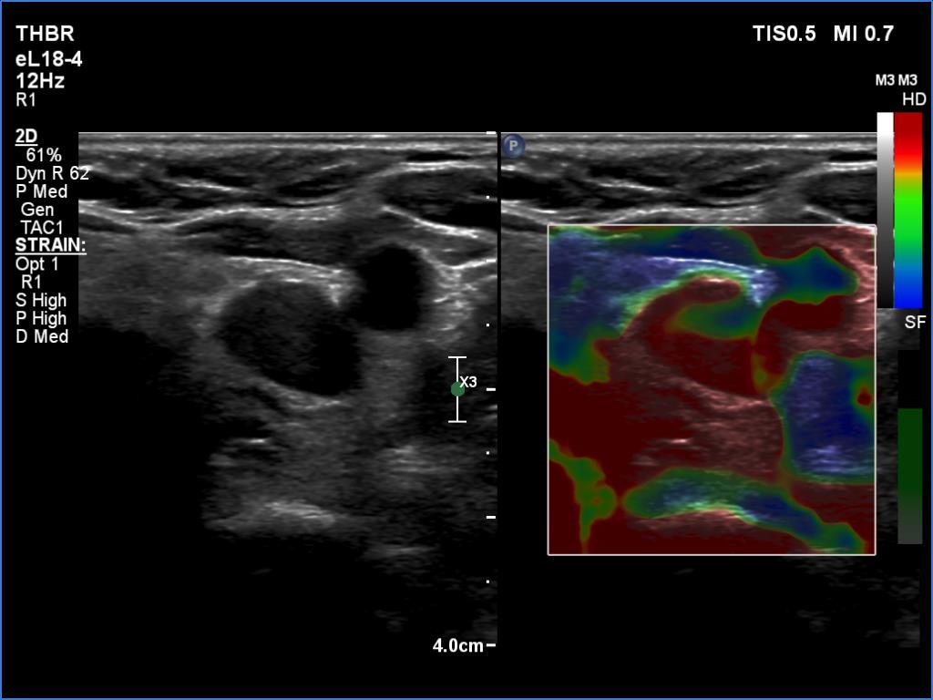 Right lobe, longitudinal scan