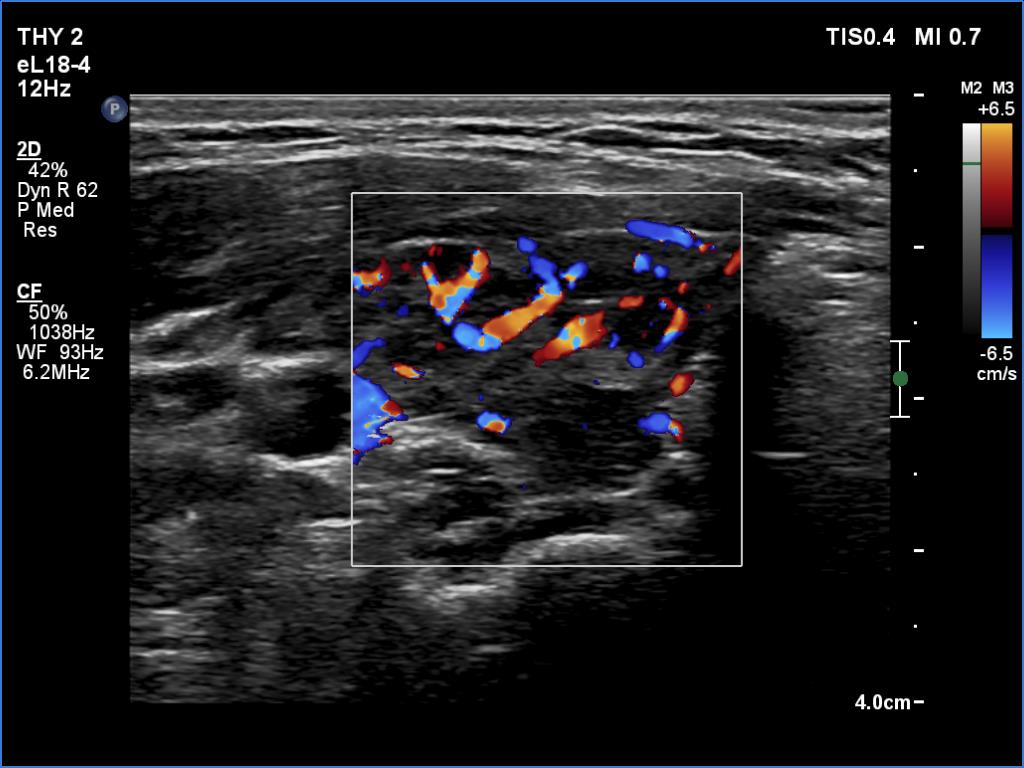 Right lobe, longitudinal scan
