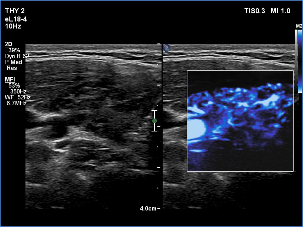 Right lobe, longitudinal scan