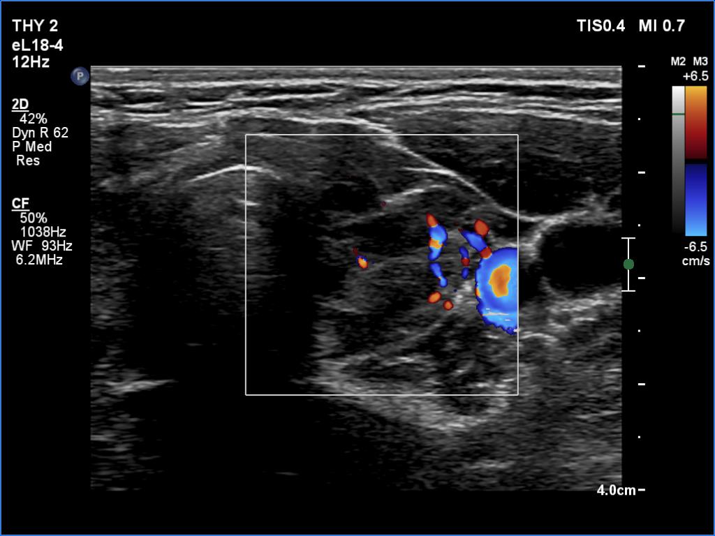 Right lobe, longitudinal scan