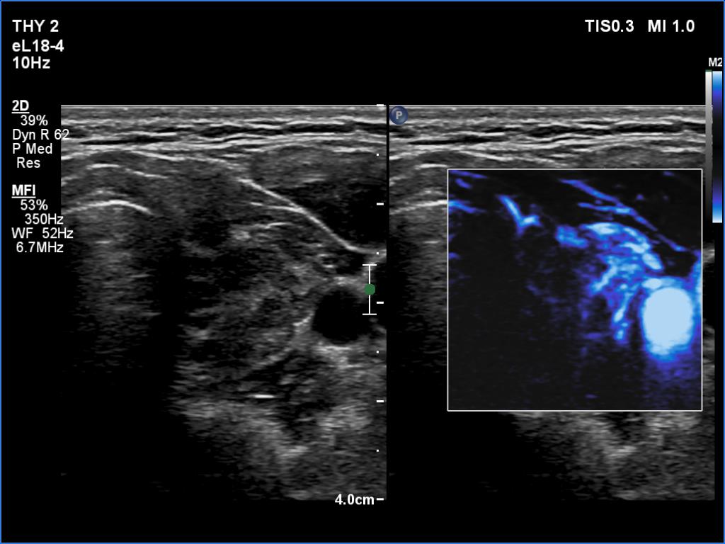 Right lobe, longitudinal scan