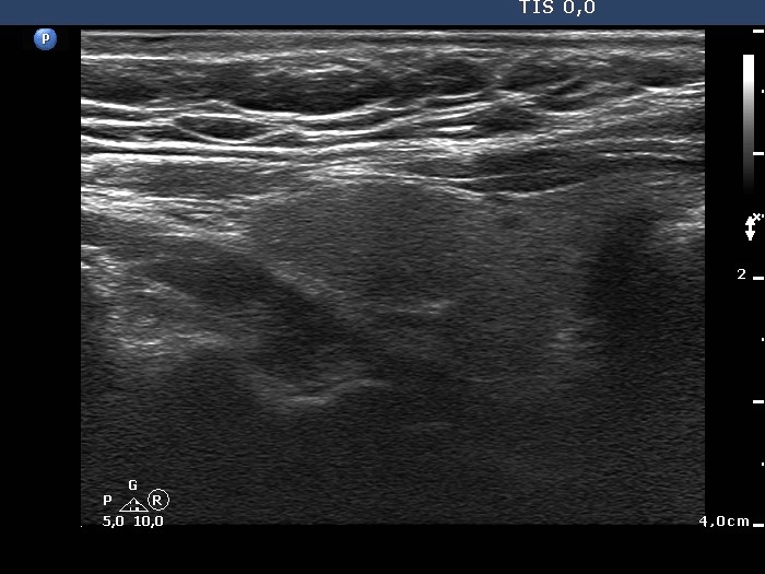 Right lobe, longitudinal scan