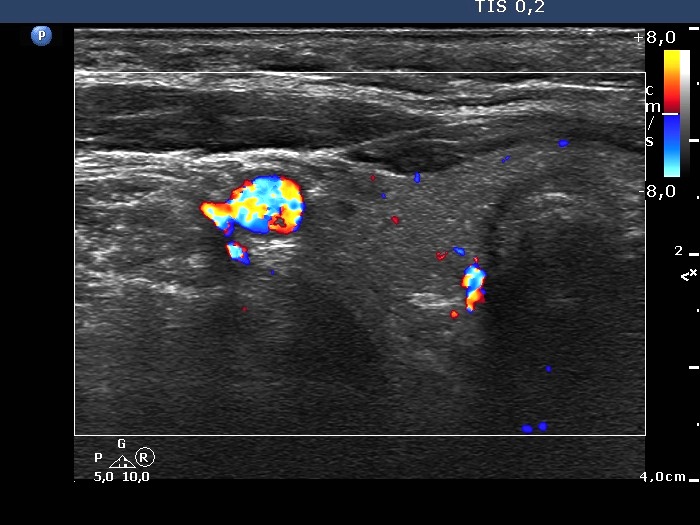 Right lobe, longitudinal scan