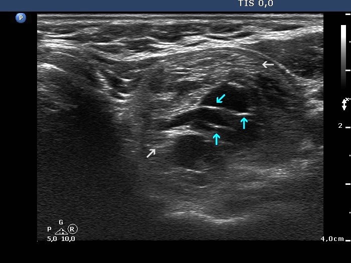 Right lobe, longitudinal scan