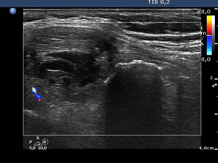 Right lobe, longitudinal scan