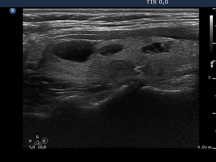Right lobe, longitudinal scan
