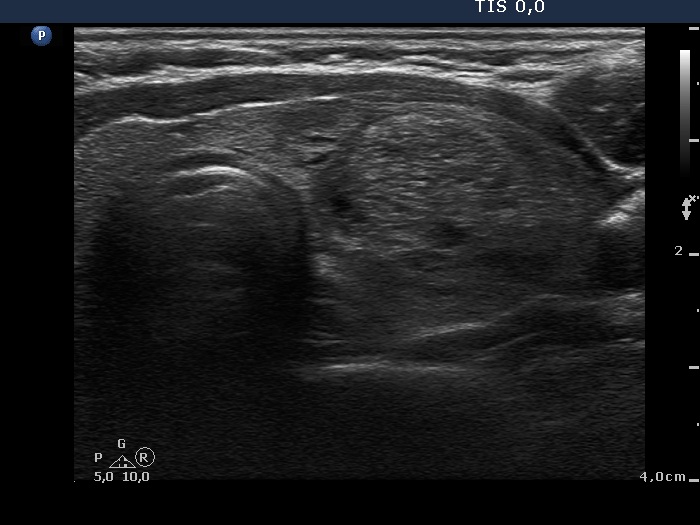 Right lobe, longitudinal scan