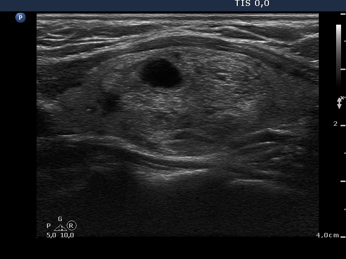 Right lobe, longitudinal scan