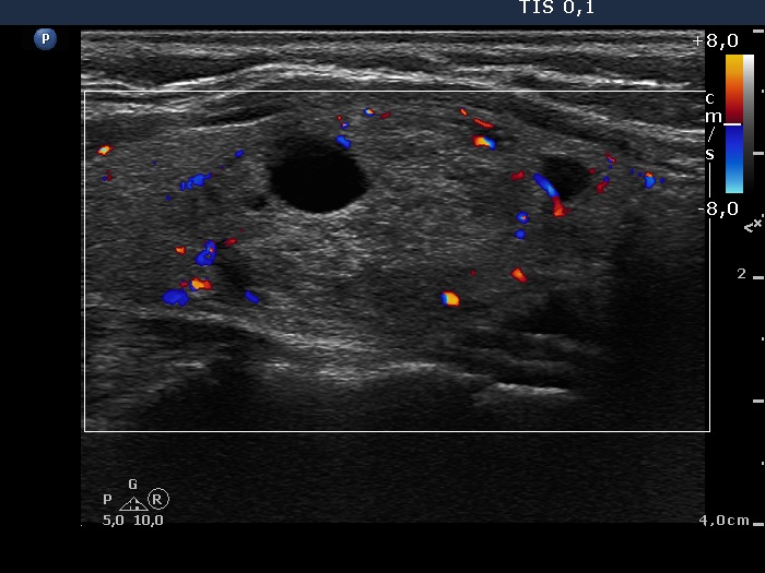 Right lobe, longitudinal scan