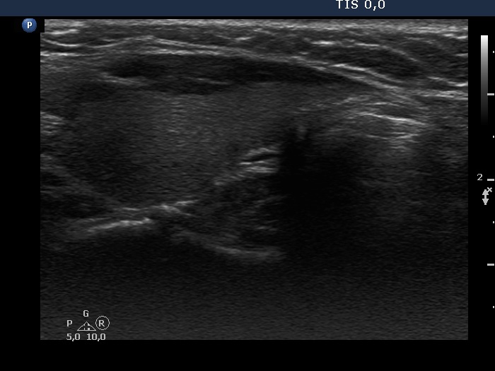 Right lobe, longitudinal scan