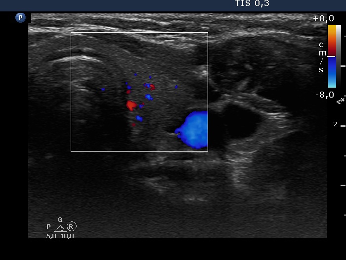 Right lobe, longitudinal scan