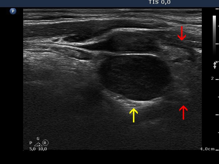 Right lobe, longitudinal scan