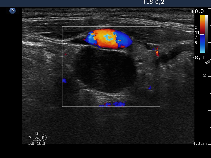 Right lobe, longitudinal scan