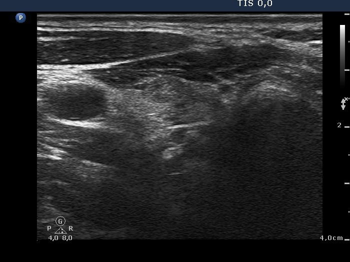 Right lobe, longitudinal scan