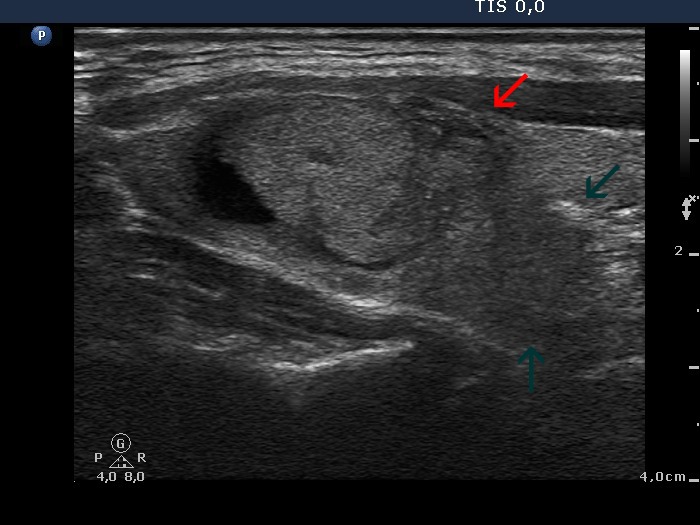 Right lobe, longitudinal scan