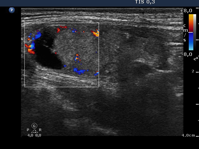 Right lobe, longitudinal scan