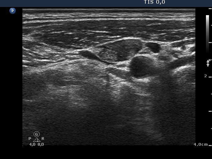 Right lobe, longitudinal scan
