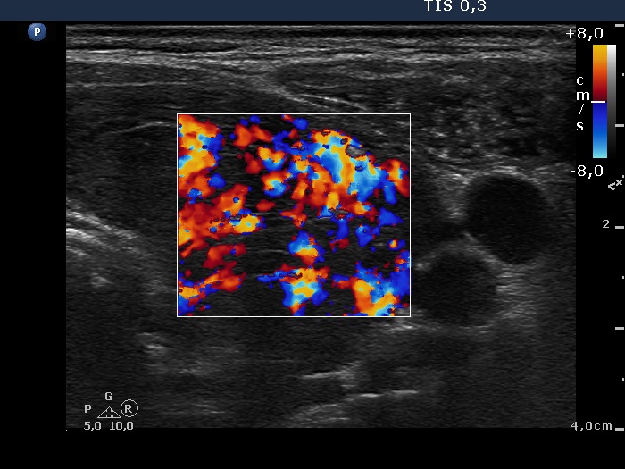Right lobe, longitudinal scan