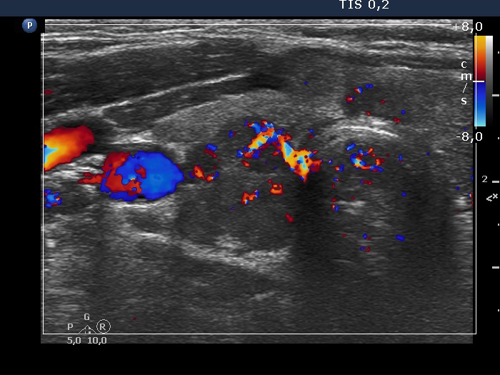 Right lobe, longitudinal scan
