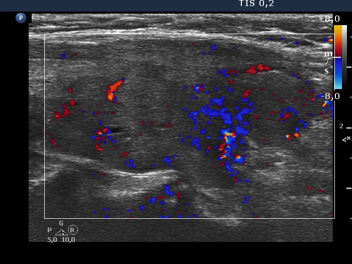 Right lobe, longitudinal scan