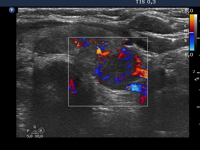 Right lobe, longitudinal scan