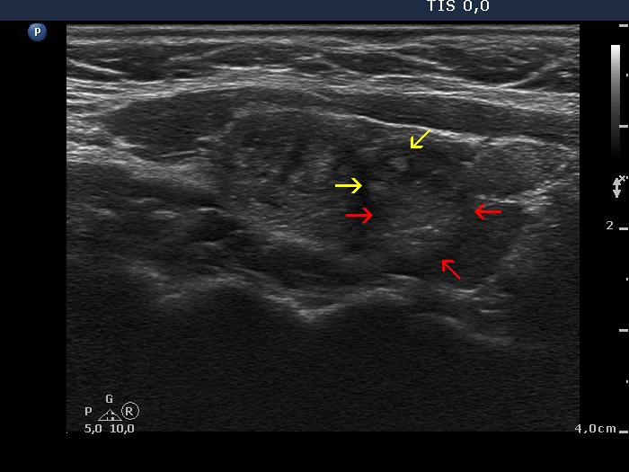 Right lobe, longitudinal scan