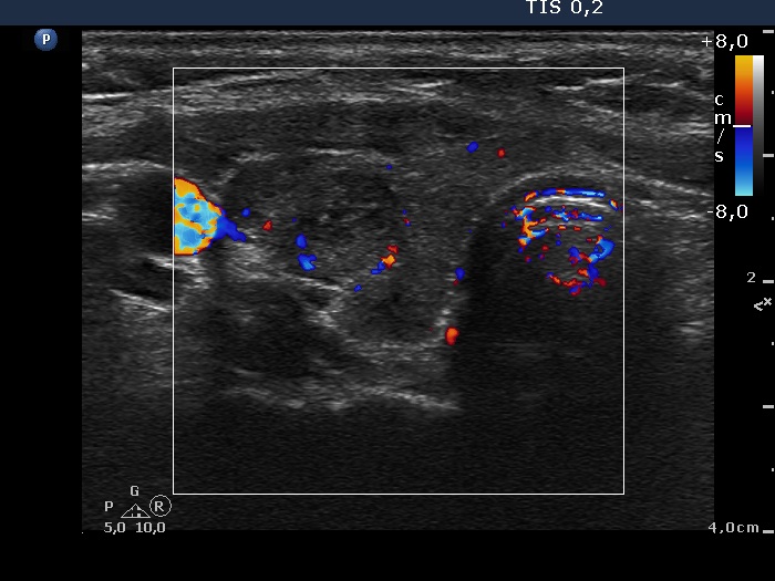 Right lobe, longitudinal scan
