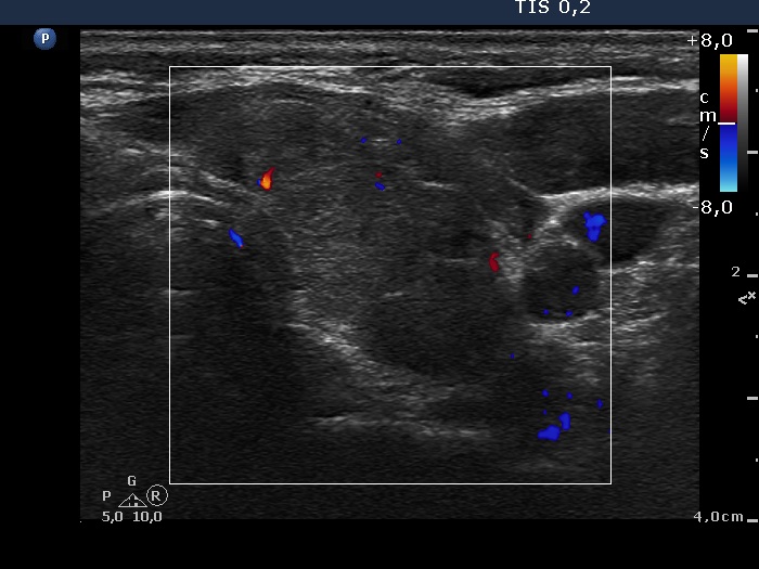 Right lobe, longitudinal scan