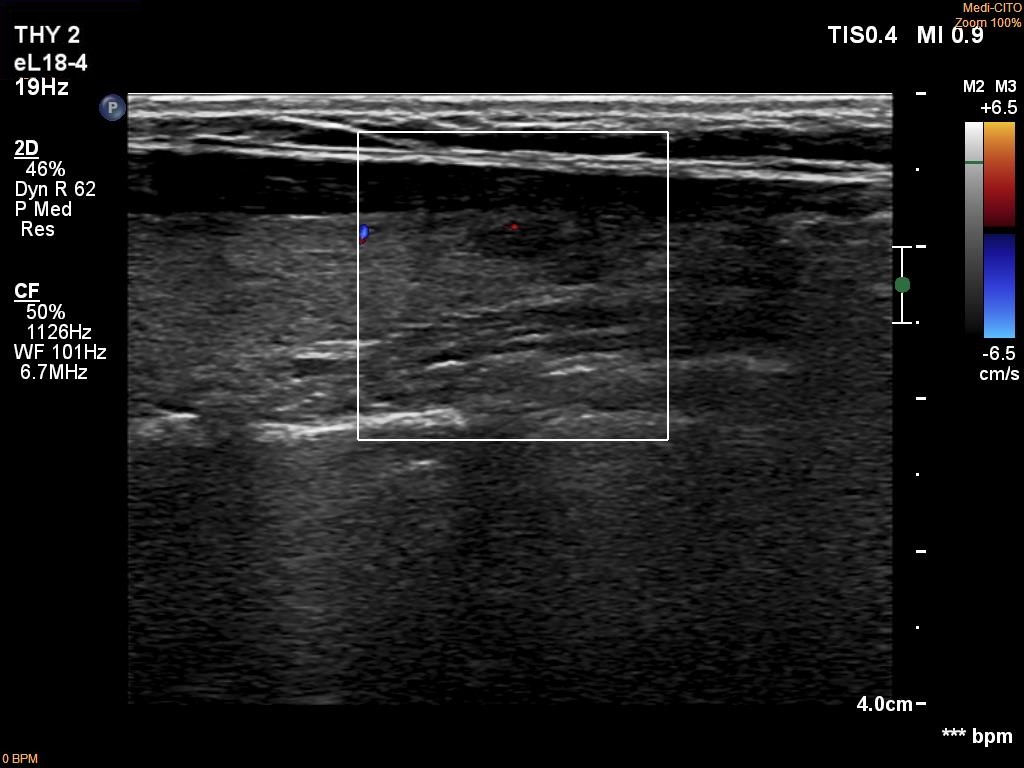 Right lobe, longitudinal scan