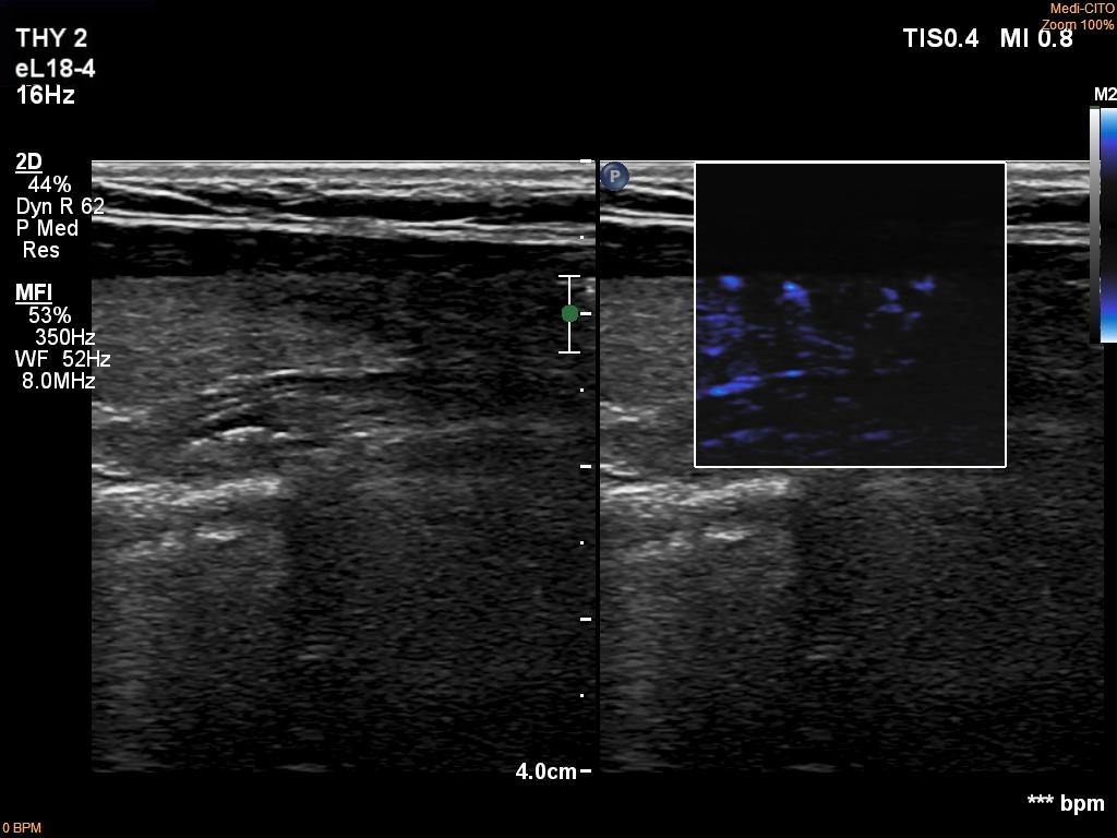 Right lobe, longitudinal scan