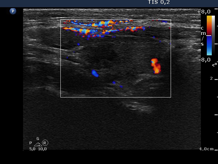 Right lobe, longitudinal scan