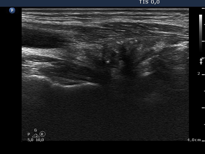 Right lobe, longitudinal scan