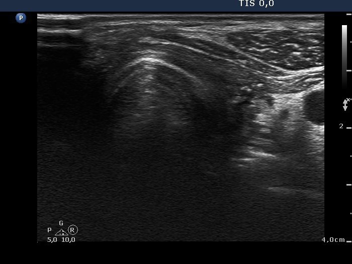 Right lobe, longitudinal scan