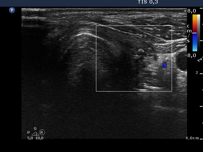 Right lobe, longitudinal scan
