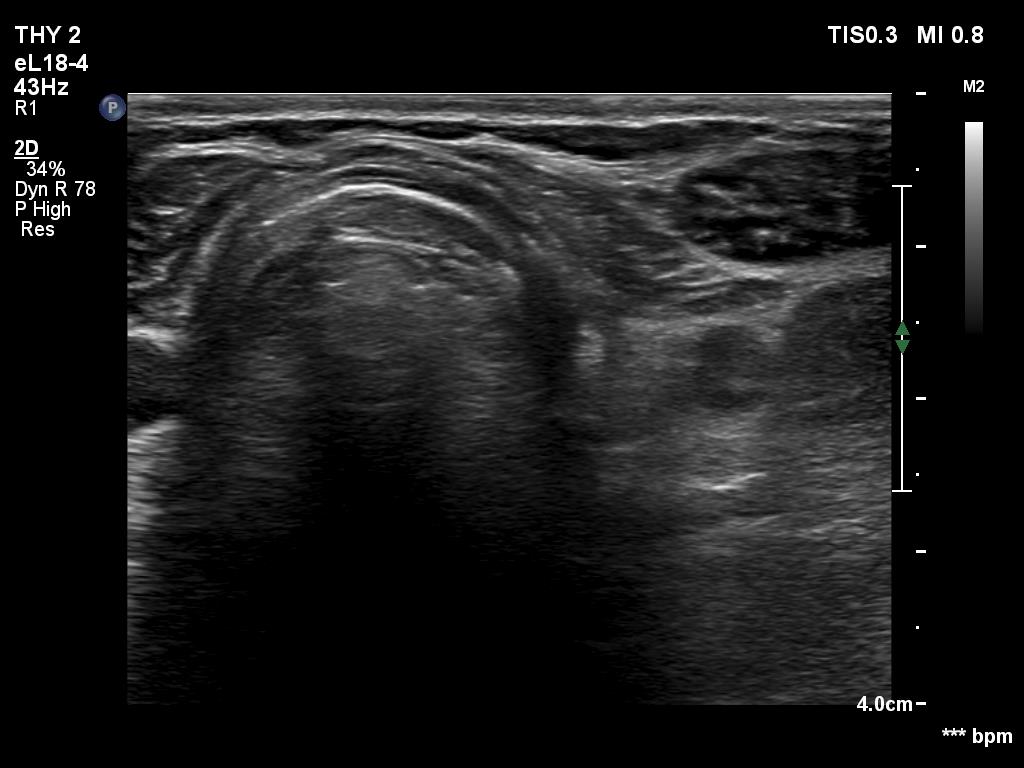 Right lobe, longitudinal scan