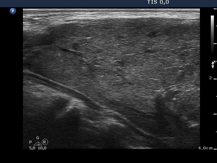 Right lobe, longitudinal scan
