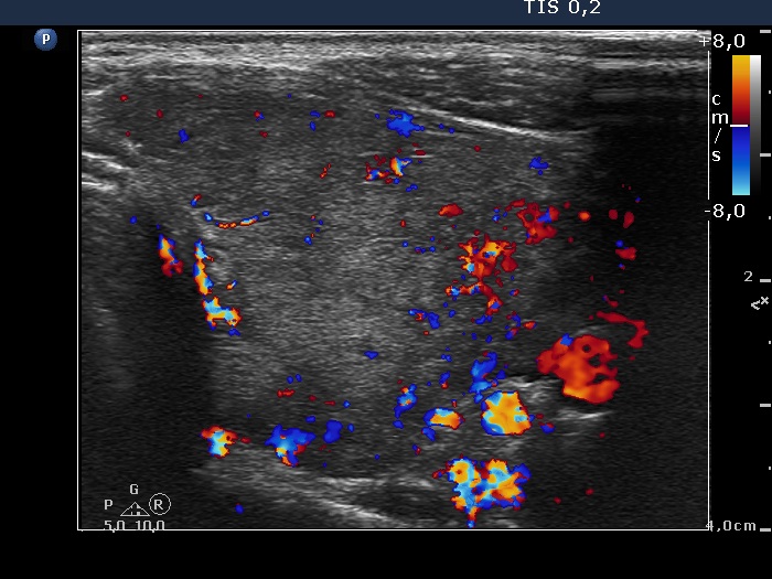Right lobe, longitudinal scan